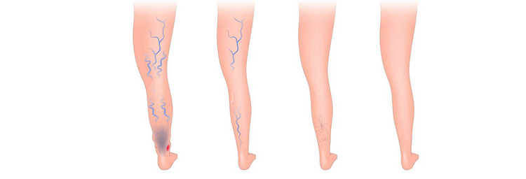 China Advanced Diode Lasers for Varicose Veins Treatment – 980nm ...